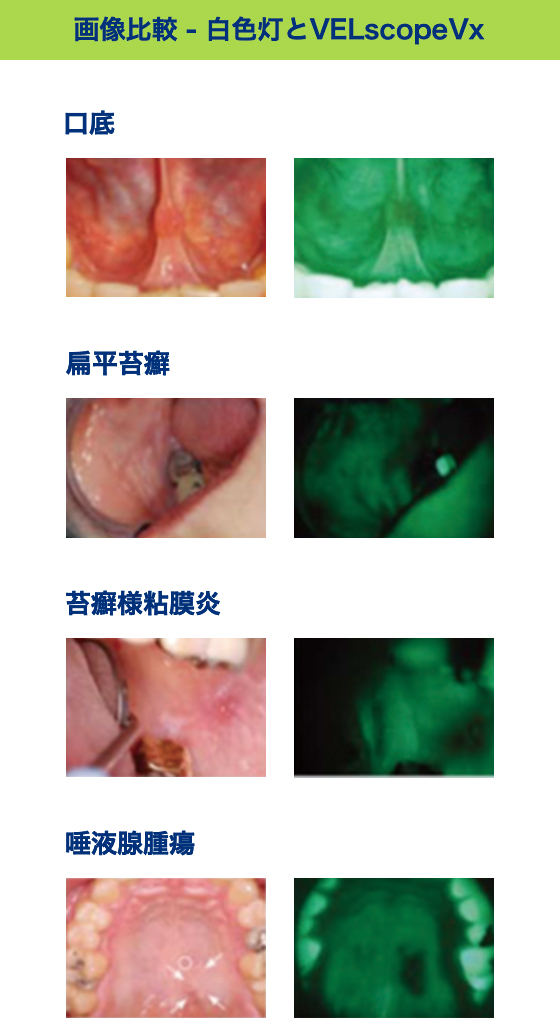画像比較 - 白色灯とVELscopeVx 口底 扁平苔癬 苔癬様粘膜炎 唾液腺腫瘍